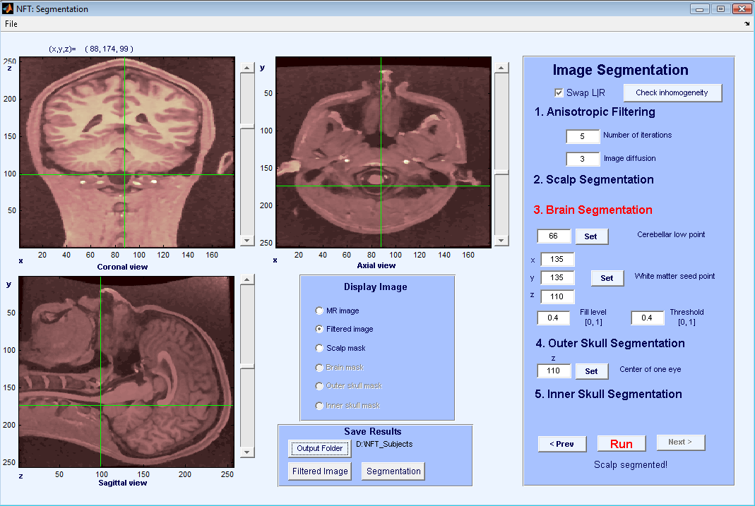 Figure 4: Interface of segmentation during setting lowest point for cerebellum.
